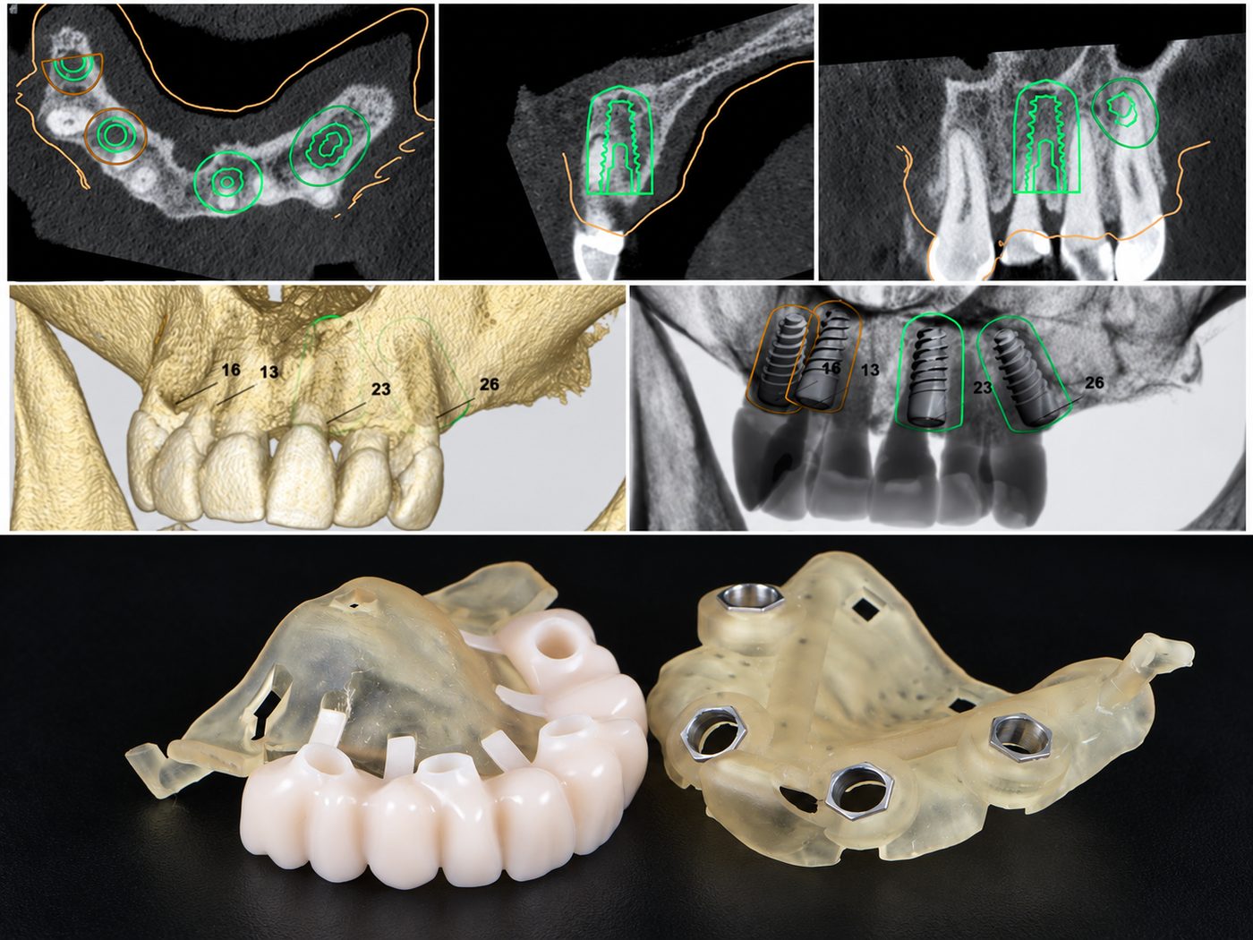 Implantacijos ir protezavimo diagnostika / planavimas